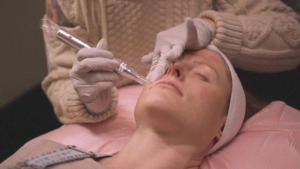 Microneedling